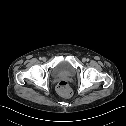 File:Active lower gastrointestinal bleeding - diverticular (Radiopaedia 61203-69106 Axial C+ portal venous phase 124).jpg