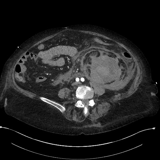 File:Active renal extravasation with large subcapsular and retroperitoneal hemorrhage (Radiopaedia 60975-68796 Axial C+ arterial phase 116).jpg
