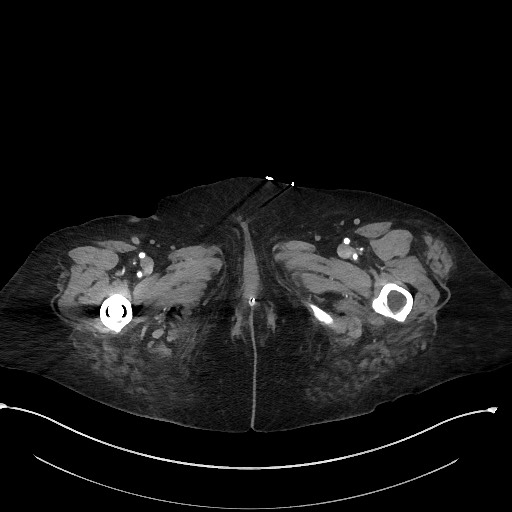 Active renal extravasation with large subcapsular and retroperitoneal hemorrhage (Radiopaedia 60975-68796 Axial C+ arterial phase 219).jpg