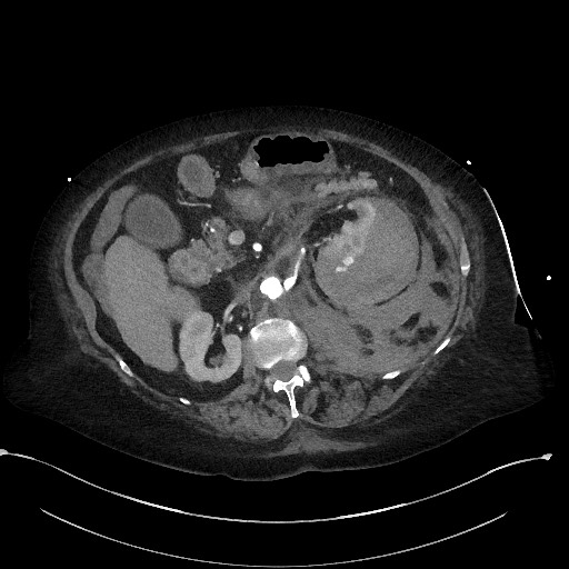 File:Active renal extravasation with large subcapsular and retroperitoneal hemorrhage (Radiopaedia 60975-68796 Axial C+ arterial phase 76).jpg