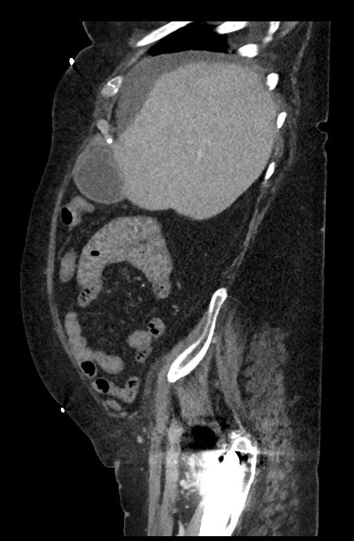 Active renal extravasation with large subcapsular and retroperitoneal hemorrhage (Radiopaedia 60975-68796 Sagittal C+ portal venous phase 172).jpg