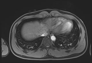 Active right ventricular cardiac sarcoidosis (Radiopaedia 55596-62100 Axial Post contrast Dixon 62).jpg