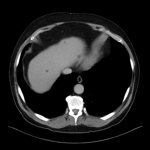Acute-on-chronic pancreatitis (Radiopaedia 67286-76656 Axial C+ portal venous phase 10).jpg