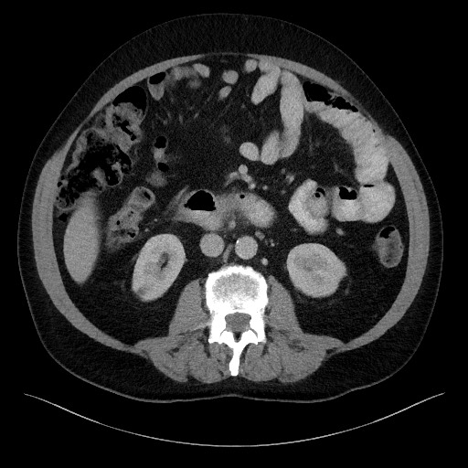 Acute-on-chronic pancreatitis (Radiopaedia 67286-76656 Axial C+ portal venous phase 38).jpg
