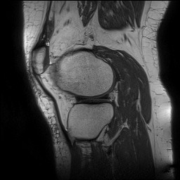 Acute-on-chronic transient lateral patellar dislocation with trochlear dysplasia (Radiopaedia 84099-99349 Sagittal PD 119).jpg