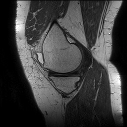 Acute-on-chronic transient lateral patellar dislocation with trochlear dysplasia (Radiopaedia 84099-99349 Sagittal PD 48).jpg