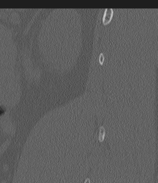 Acute L1 burst compression fracture (Radiopaedia 34430-35755 Sagittal bone window 58).png