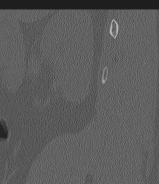 Acute L1 burst compression fracture (Radiopaedia 34430-35755 Sagittal bone window 66).png