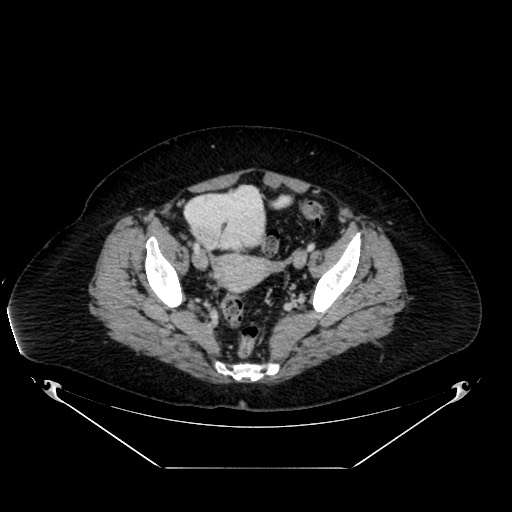 File:Acute appendicitis, heterotaxy syndrome (Radiopaedia 66884-76202 Axial C+ portal venous phase 109).jpg