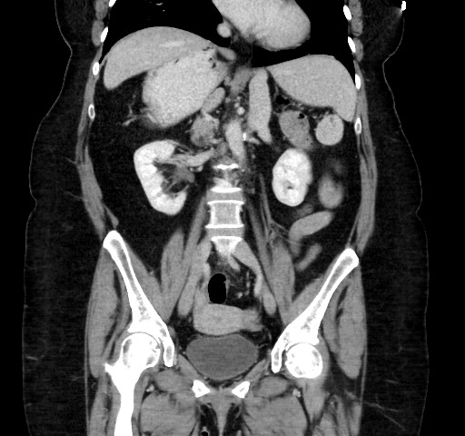 Acute appendicitis, heterotaxy syndrome (Radiopaedia 66884-76202 Coronal C+ portal venous phase 67).jpg