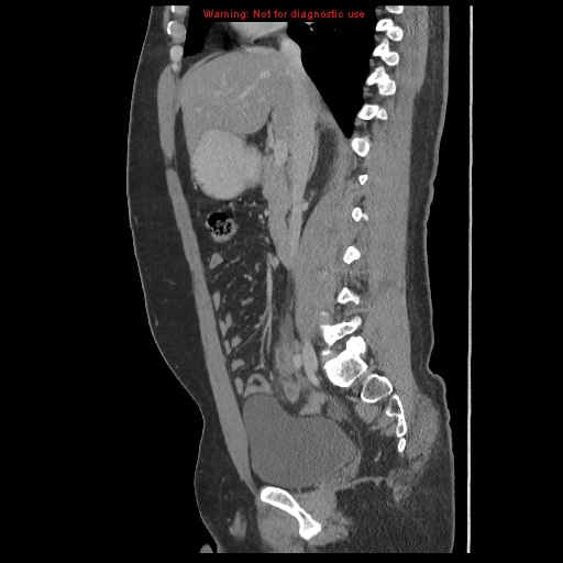 File:Acute appendicitis (Radiopaedia 10498-10973 Sagittal C+ portal venous phase 22).jpg