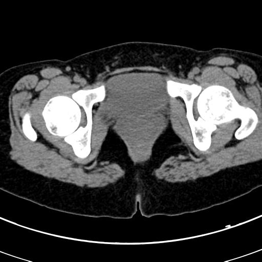 Acute appendicitis (Radiopaedia 30261-30888 Axial non-contrast 109).jpg
