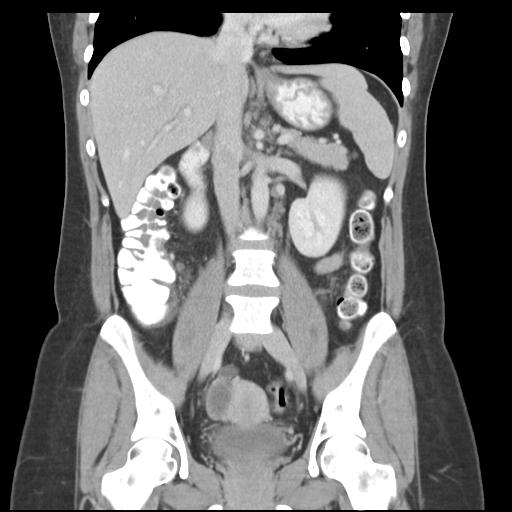 Acute appendicitis (Radiopaedia 30297-30934 Coronal C+ portal venous phase 25).jpg