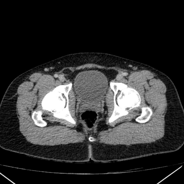 File:Acute appendicitis (Radiopaedia 38255-40270 Axial C+ portal venous phase 107).jpg