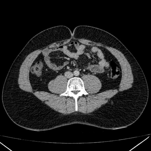 File:Acute appendicitis (Radiopaedia 38255-40270 Axial C+ portal venous phase 62).jpg