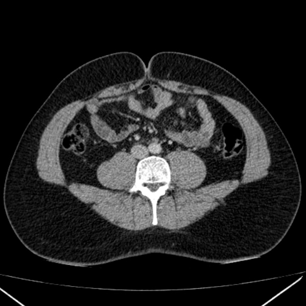 Acute appendicitis (Radiopaedia 38255-40270 Axial C+ portal venous phase 63).jpg