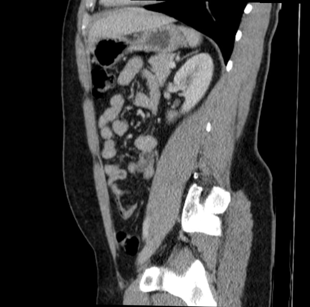 Acute appendicitis (Radiopaedia 38255-40270 Sagittal C+ portal venous phase 55).jpg