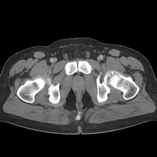 Acute appendicitis (Radiopaedia 48511-53463 Axial C+ portal venous phase 103).jpg