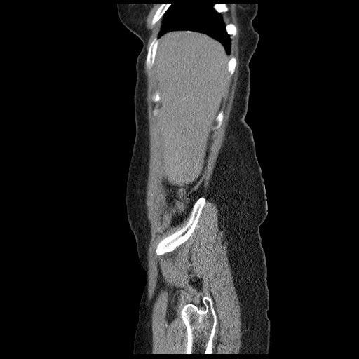 File:Acute appendicitis (Radiopaedia 52672-58589 Sagittal C+ arterial phase 3).jpg