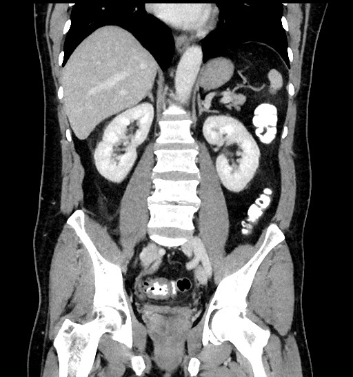 Acute appendicitis (Radiopaedia 77016-88960 Coronal C+ portal venous phase 61).jpg