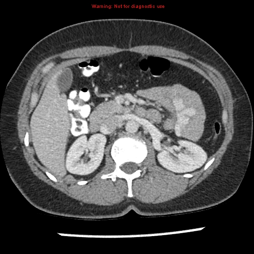 Acute appendicitis (Radiopaedia 7966-8812 C+ portal venous phase 13).jpg