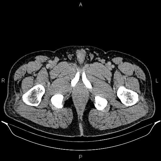 File:Acute appendicitis (Radiopaedia 84780-100240 Axial C+ portal venous phase 117).jpg