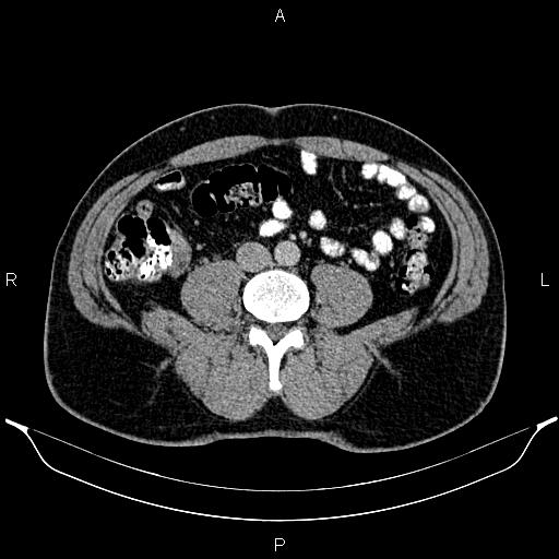 Acute appendicitis (Radiopaedia 84780-100240 Axial C+ portal venous phase 66).jpg