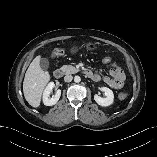 Acute appendicitis - large appendicoliths (Radiopaedia 61805-69820 Axial C+ portal venous phase 50).jpg