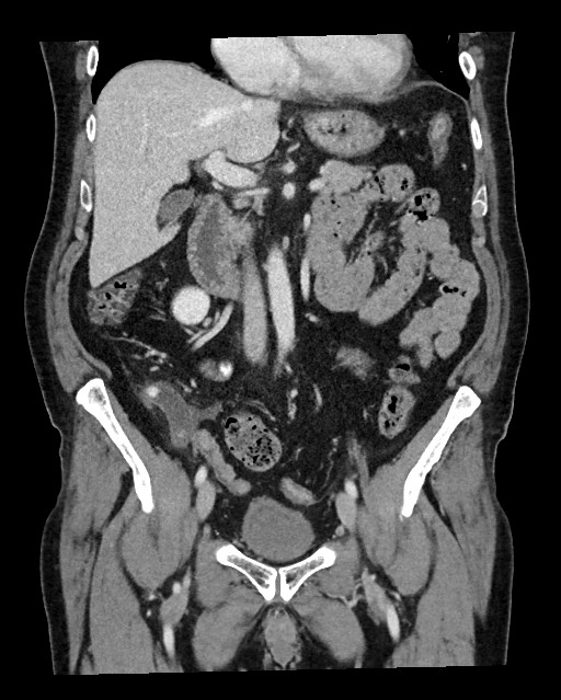 Acute appendicitis - large appendicoliths (Radiopaedia 61805-69820 Coronal C+ portal venous phase 61).jpg