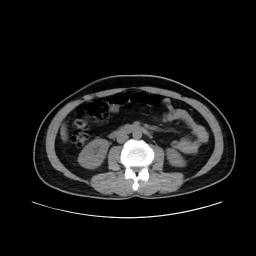 Acute appendicitis and COVID 19 pneumonia (Radiopaedia 76604-88380 Axial non-contrast 76).jpg