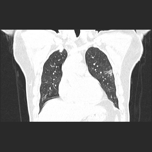 Acute appendicitis and COVID 19 pneumonia (Radiopaedia 76604-88380 G 23).jpg