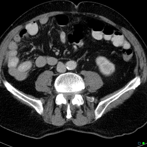 File:Acute appendicitis arising from a malrotated cecum (Radiopaedia 19970-19997 Axial C+ portal venous phase 22).jpg