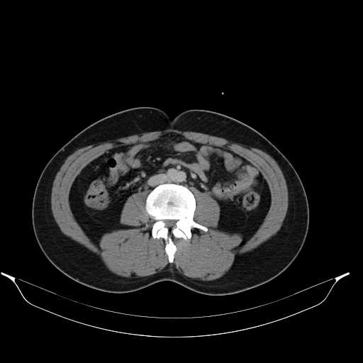 File:Acute appendicitis with appendicoliths (Radiopaedia 21148-21062 Axial C+ portal venous phase 2).jpg