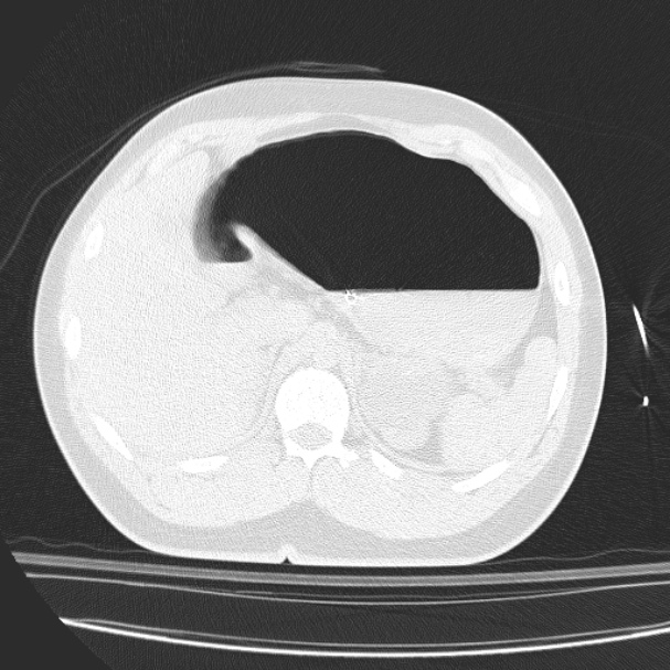 Acute aspiration pneumonitis (Radiopaedia 33605-34703 Axial lung window 98).jpg