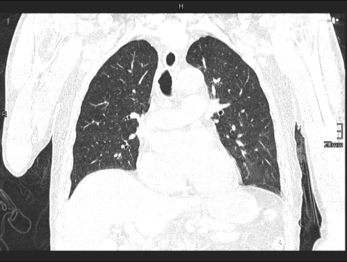 Acute aspiration pneumonitis (Radiopaedia 55642-62166 Coronal lung window 47).jpg