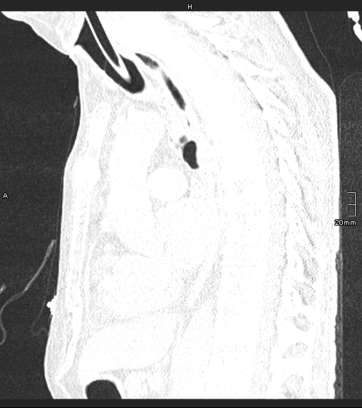 Acute aspiration pneumonitis (Radiopaedia 55642-62166 Sagittal lung window 74).jpg