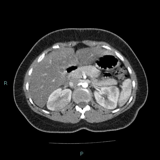 Acute bilateral pyelonephritis (Radiopaedia 37146-38881 Axial C+ arterial phase 62).jpg