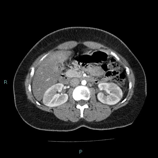 File:Acute bilateral pyelonephritis (Radiopaedia 37146-38881 Axial C+ arterial phase 78).jpg