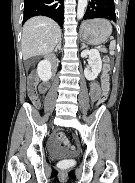 Acute bowel ischemia (Radiopaedia 87695-104114 Coronal C+ portal venous phase 251).jpg