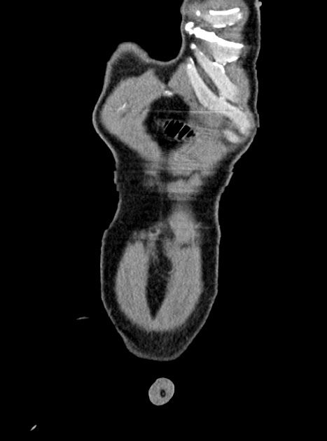 Acute bowel ischemia (Radiopaedia 87695-104114 Coronal C+ portal venous phase 69).jpg