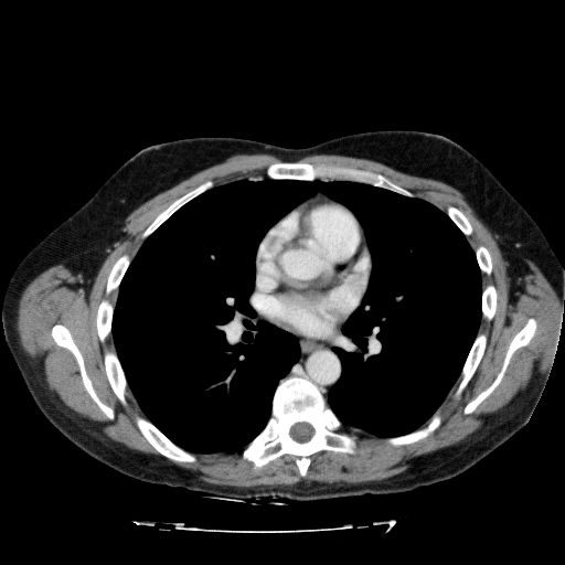 Acute cholecystitis and incidental left sided IVC (Radiopaedia 49352-54459 Axial C+ portal venous phase 4).jpg