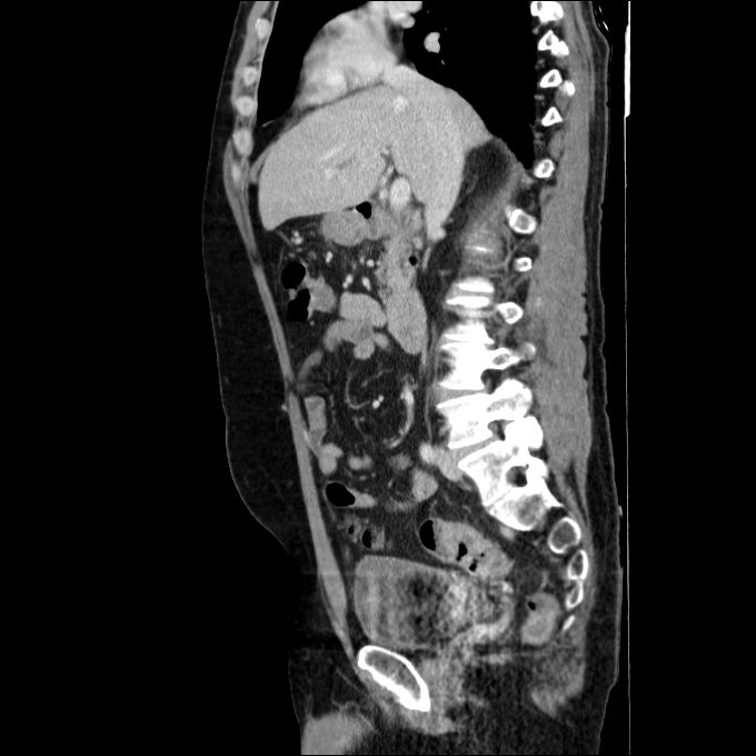 Acute cholecystitis and incidental left sided IVC (Radiopaedia 49352-54459 Sagittal C+ portal venous phase 53).jpg