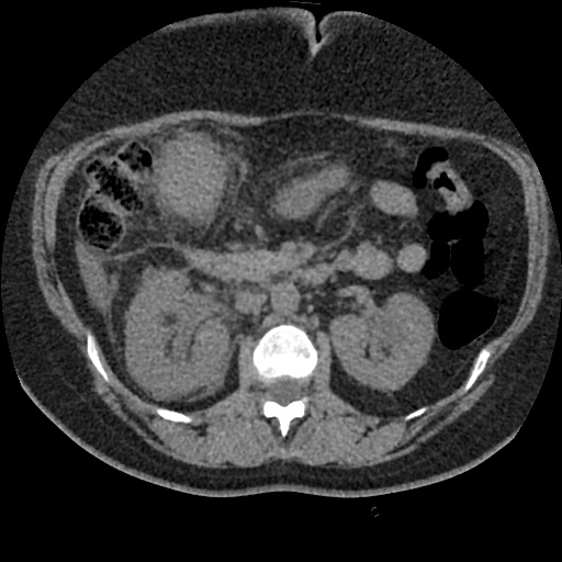 File:Acute cholecystitis and ureteric colic (Radiopaedia 42330-45444 Axial prone 36).jpg