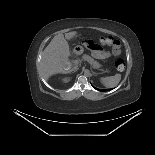 Acute cholecystitis with tensile fundus sign (Radiopaedia 71394-81723 Axial non-contrast 14).jpg