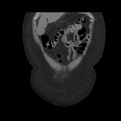 Acute cholecystitis with tensile fundus sign (Radiopaedia 71394-81723 Coronal non-contrast 30).jpg