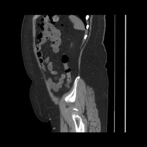 Acute cholecystitis with tensile fundus sign (Radiopaedia 71394-81723 Sagittal non-contrast 131).jpg