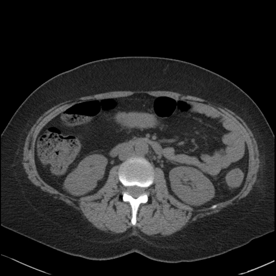 Acute colonic hemorrhage in ulcerative colitis (Radiopaedia 77415-89538 Axial non-contrast 61).jpg