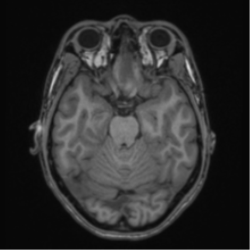 Acute disseminated encephalomyelitis (ADEM) (Radiopaedia 65319-74349 Axial T1 20).png