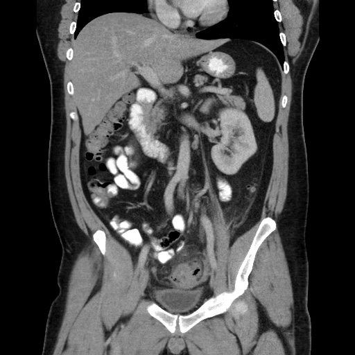 Acute diverticulitis with localized perforation (Radiopaedia 41296-44113 Coronal C+ portal venous phase 32).jpg