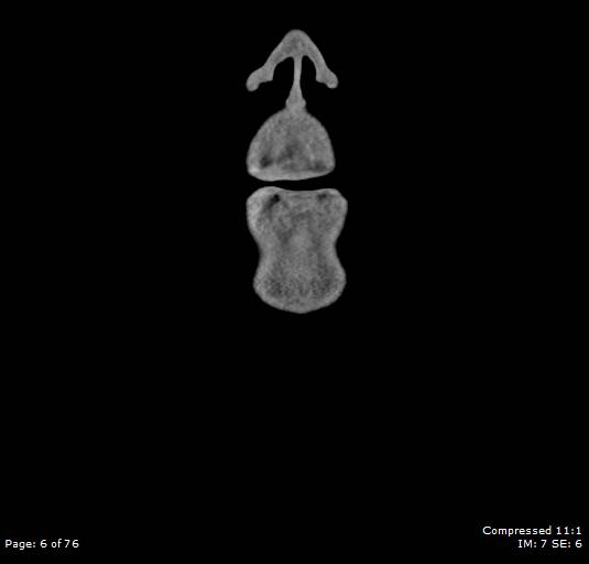 Acute epiglottitis (Radiopaedia 54375-60590 Coronal C+ arterial phase 6).jpg